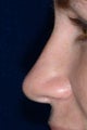 Nonsurgical rhinoplasty