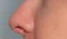 Juvederm in the nose