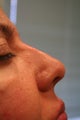 Non-surgical Rhinoplasty