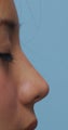 Non Surgical Rhinoplasty