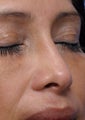 Non Surgical Rhinoplasty