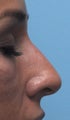 Non Surgical Rhinoplasty