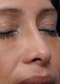 Non-Surgical Nose Job