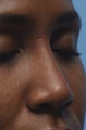 Non-Surgical Nose Job