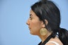 Nonsurgical Rhinoplasty
