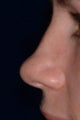 Nonsurgical rhinoplasty