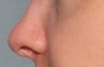 Juvederm in the nose