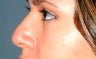 Non-surgical nose job with Restylane