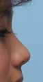 Non Surgical Rhinoplasty