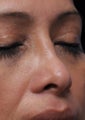 Non Surgical Rhinoplasty