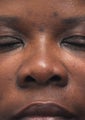 Non Surgical Rhinoplasty
