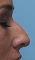 Non Surgical Rhinoplasty