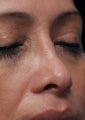 Non-Surgical Nose Job
