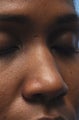 Non-Surgical Nose Job