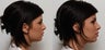 Non Surgical Nose Job Rhinoplasty