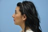 Nonsurgical Rhinoplasty