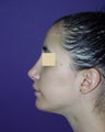 Nose and chin surgery