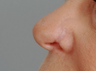 Reconstruction Nasal Scar