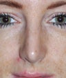 Rhinoplasty in 22 Year-Old Female