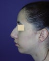 Nose and chin surgery