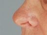 Reconstruction Nasal Scar