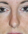 Rhinoplasty in 22 Year-Old Female
