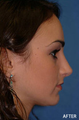 Rhinoplasty