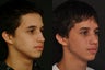Rhinoplasty