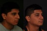Rhinoplasty