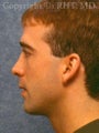 Rhinoplasty