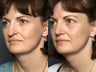 Nose Surgery