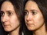 Nose Surgery