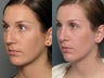 Nose Surgery