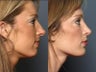 Nose Surgery