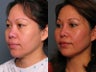 Nose Surgery