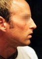 Nose Surgery