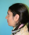 Rhinoplasty- Nose Job