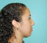 Nose Job- Rhinoplasty