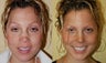 Revision Rhinoplasty Nose Surgery