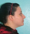 Rhinoplasty- Nose Job