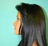 Rhinoplasty- Nose Job