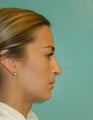Rhinoplasty- Nose job