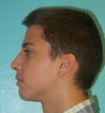 Male Nose Job- Rhinoplasty