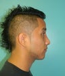 Male Nose Job- Rhinoplasty
