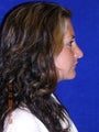 Rhinoplasty