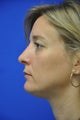 Nasal airway surgery with cosmetic improvment