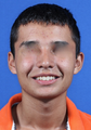 nasal airway surgery with cosmetic improvement