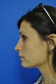 Nose surgery/Rhinoplasty