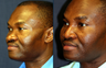 Nasal Dorsal Implant and Nostril Reduction