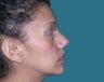 Rhinoplasty